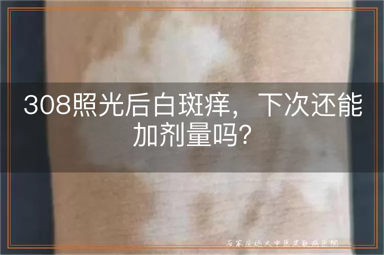 308照光后白斑痒，下次还能加剂量吗？