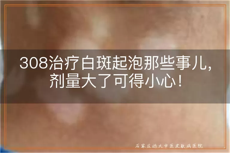 308治疗白斑起泡那些事儿，剂量大了可得小心！