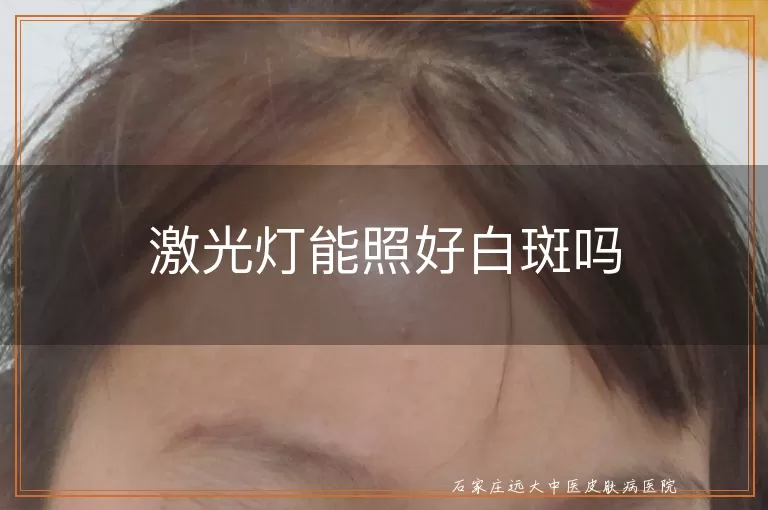 激光灯能照好白斑吗