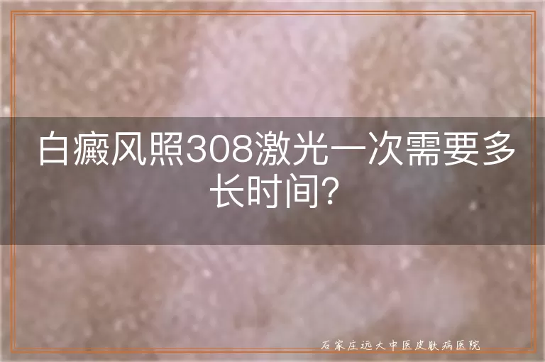 白癜风照308激光一次需要多长时间？