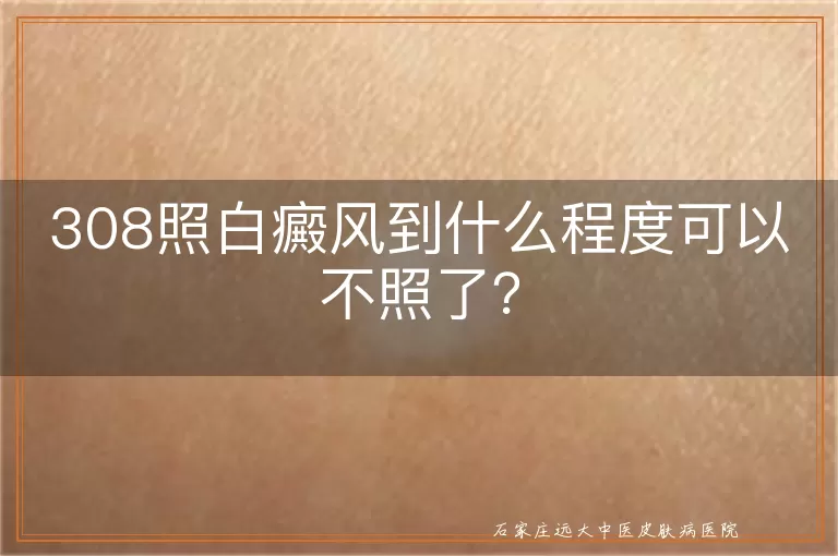 308照白癜风到什么程度可以不照了？