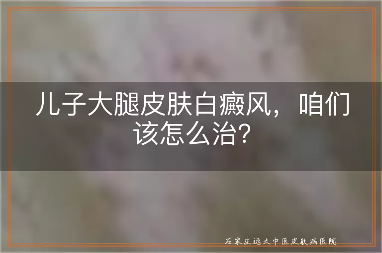 儿子大腿皮肤白癜风，咱们该怎么治？