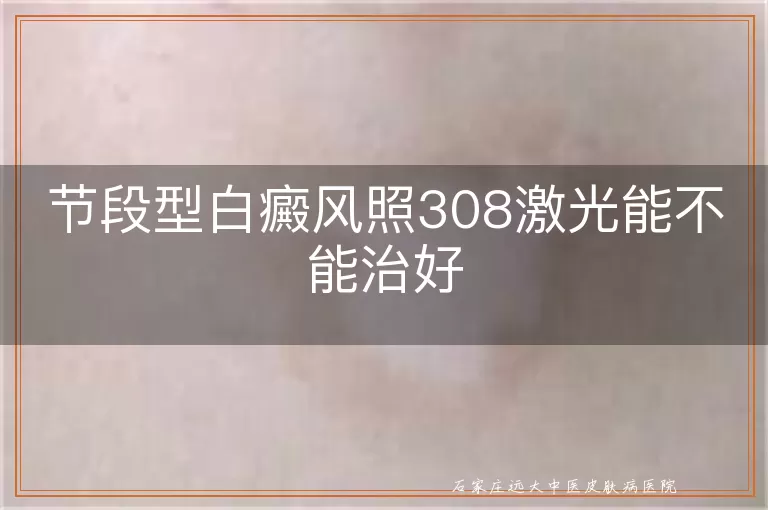 节段型白癜风照308激光能不能治好