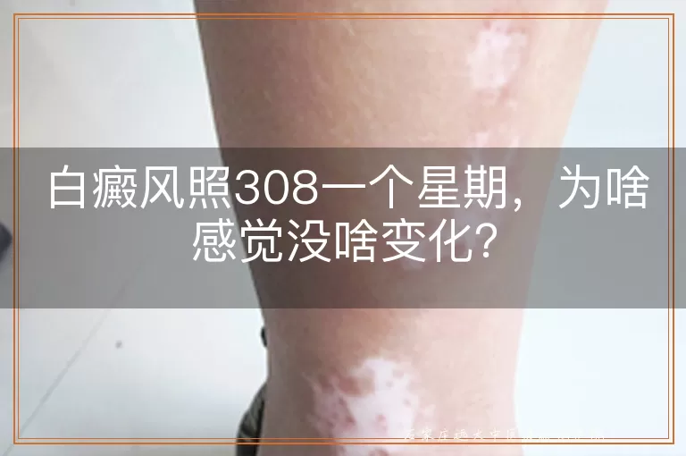 白癜风照308一个星期，为啥感觉没啥变化？