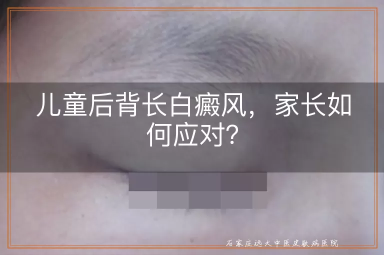儿童后背长白癜风，家长如何应对？