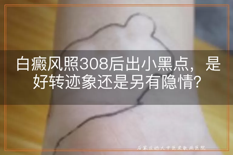 白癜风照308后出小黑点，是好转迹象还是另有隐情？