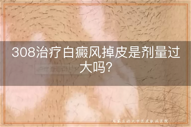 308治疗白癜风掉皮是剂量过大吗？