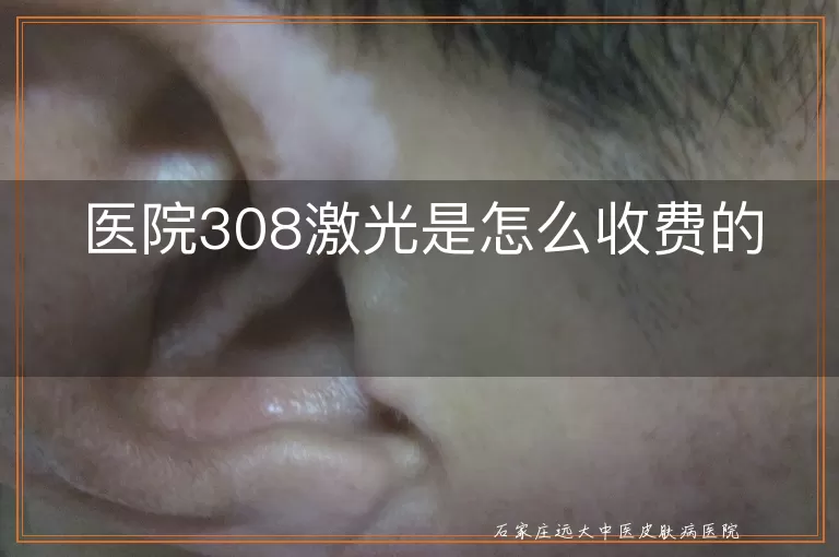 医院308激光是怎么收费的