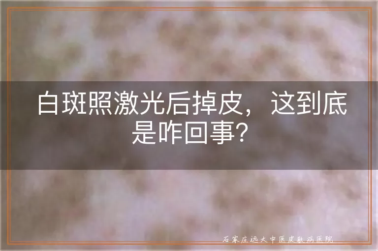 白斑照激光后掉皮，这到底是咋回事？