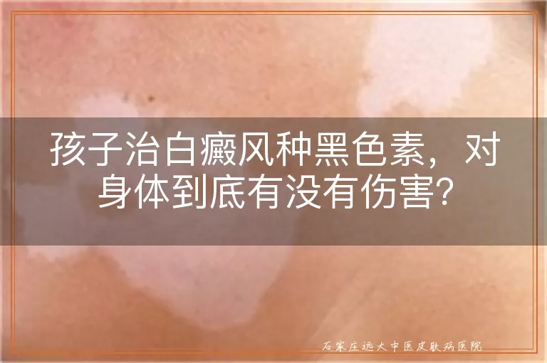 孩子治白癜风种黑色素，对身体到底有没有伤害？