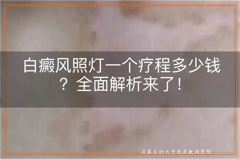 白癜风照灯一个疗程多少钱？全面解析来了！
