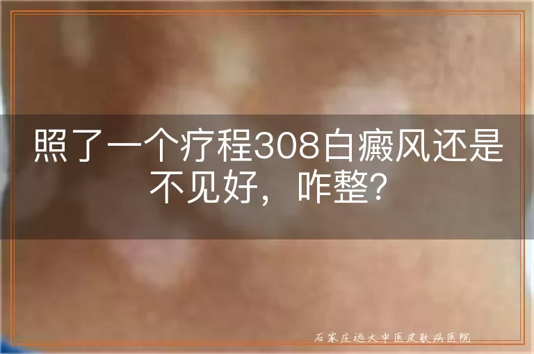 照了一个疗程308白癜风还是不见好，咋整？