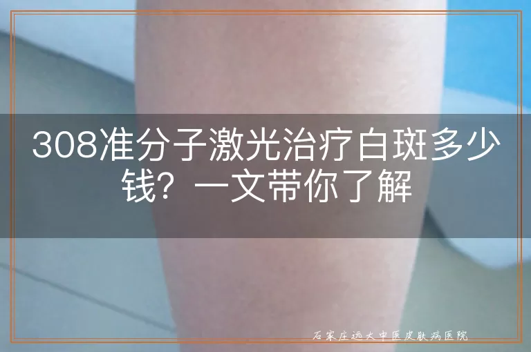 308准分子激光治疗白斑多少钱？一文带你了解