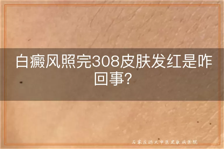 白癜风照完308皮肤发红是咋回事？