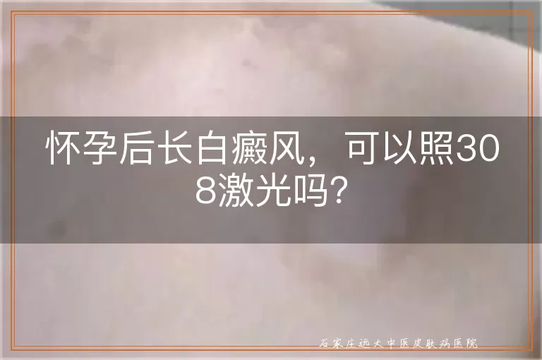 怀孕后长白癜风，可以照308激光吗？