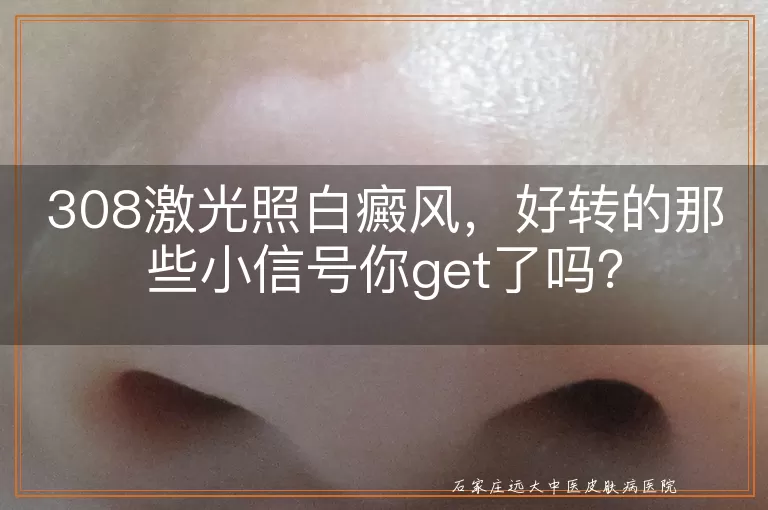 308激光照白癜风，好转的那些小信号你get了吗？