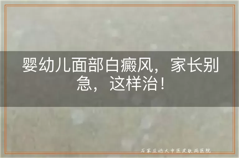 婴幼儿面部白癜风,家长别急,这样治!