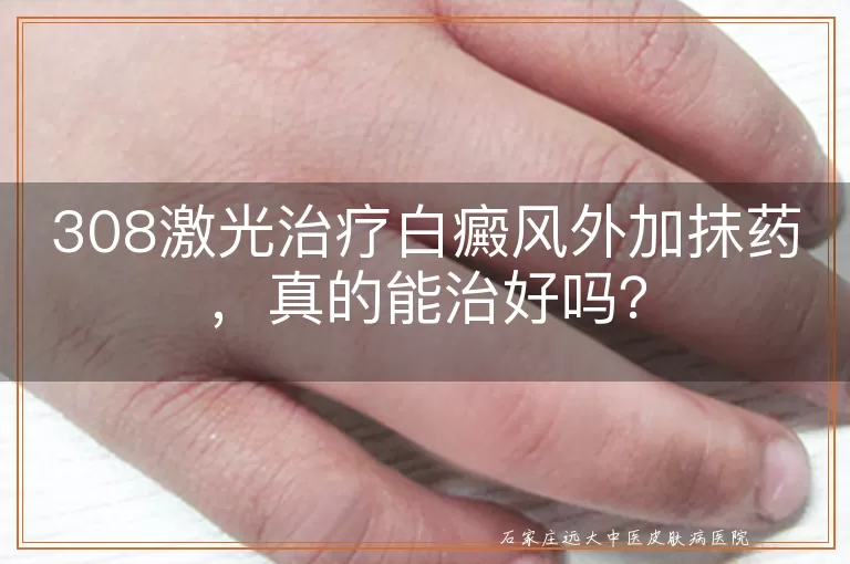 308激光治疗白癜风外加抹药，真的能治好吗？