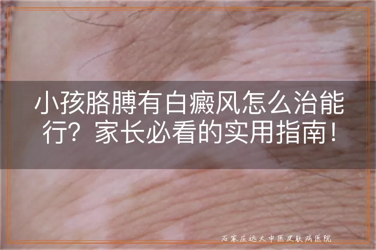 小孩胳膊有白癜风怎么治能行？家长必看的实用指南！