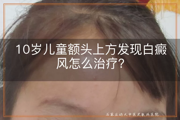 10岁儿童额头上方发现白癜风怎么治疗？