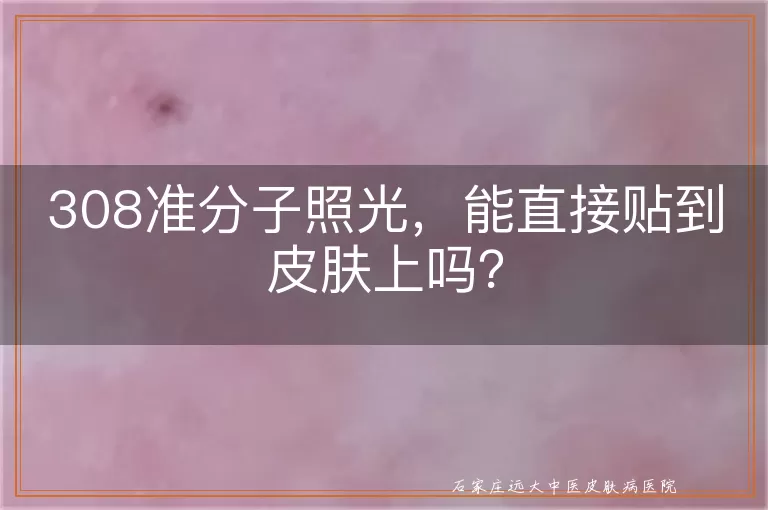 308准分子照光，能直接贴到皮肤上吗？