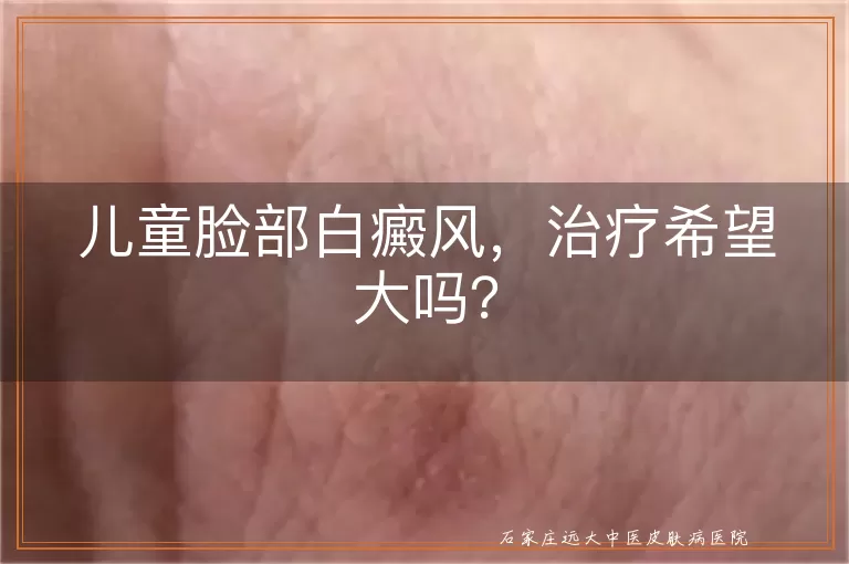 儿童脸部白癜风，治疗希望大吗？