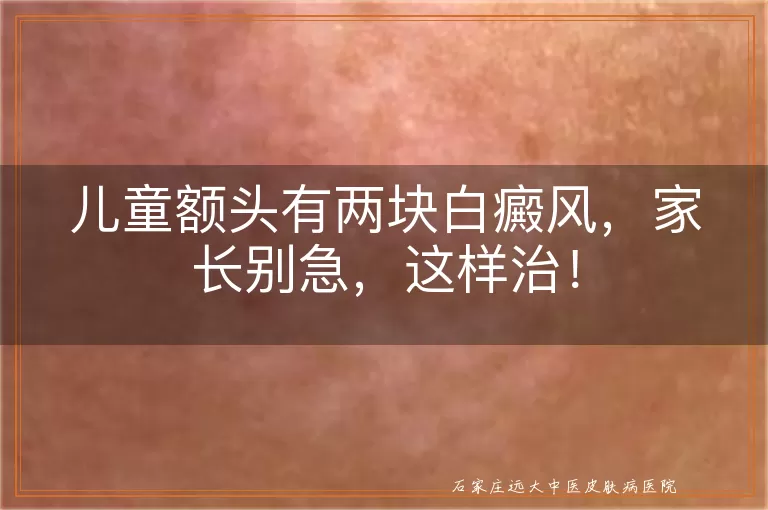儿童额头有两块白癜风，家长别急，这样治！