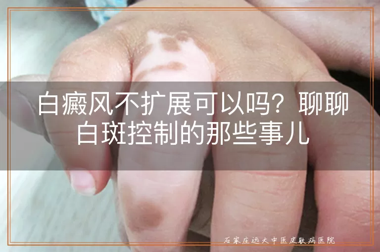 白癜风不扩展可以吗？聊聊白斑控制的那些事儿