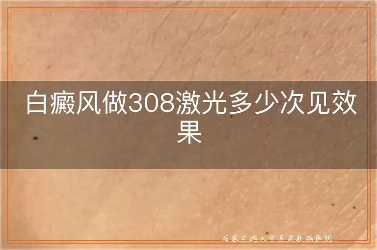 白癜风做308激光多少次见效果