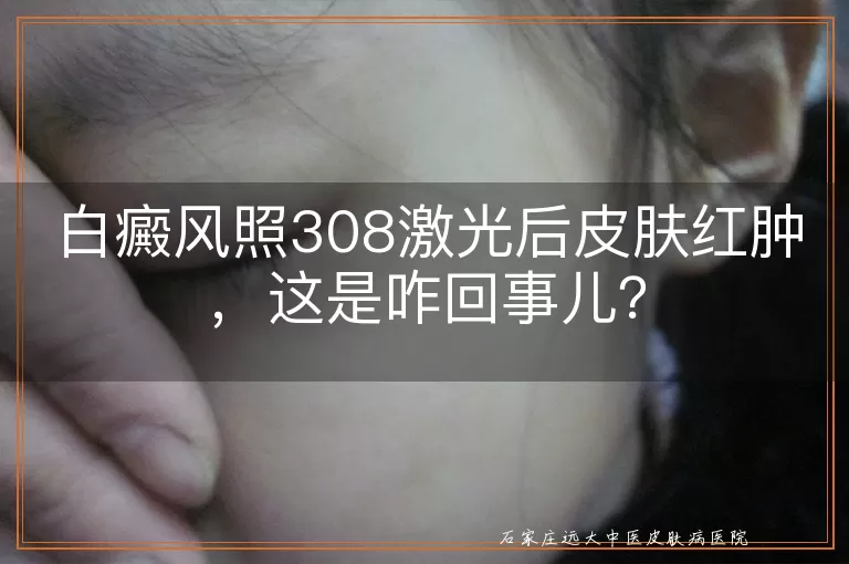 白癜风照308激光后皮肤红肿，这是咋回事儿？