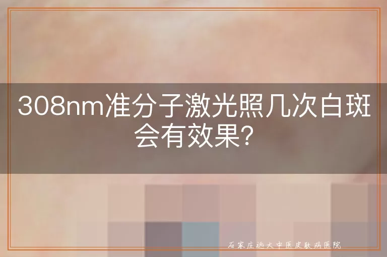 308nm准分子激光照几次白斑会有效果？