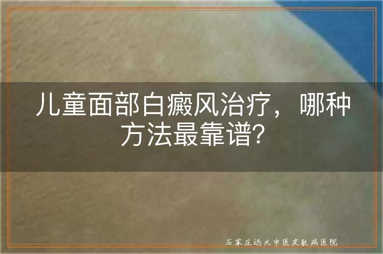儿童面部白癜风治疗，哪种方法最靠谱？