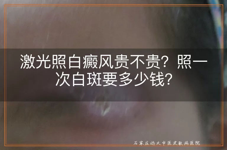 激光照白癜风贵不贵？照一次白斑要多少钱？