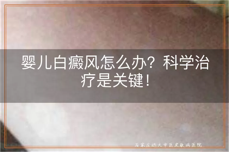婴儿白癜风怎么办？科学治疗是关键！