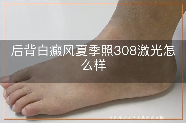 后背白癜风夏季照308激光怎么样