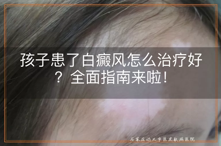 孩子患了白癜风怎么治疗好？全面指南来啦！
