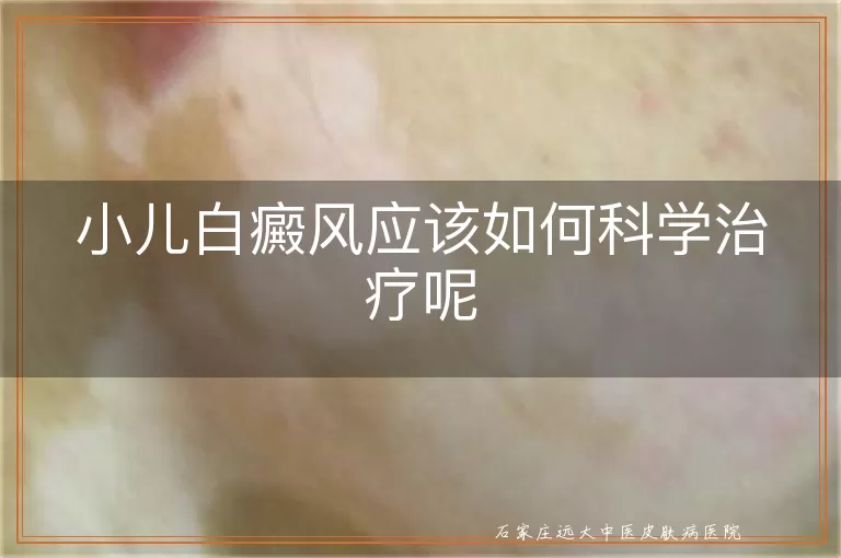 小儿白癜风应该如何科学治疗呢
