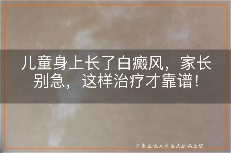 儿童身上长了白癜风，家长别急，这样治疗才靠谱！