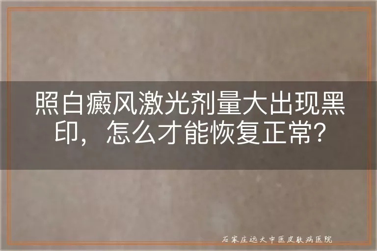 照白癜风激光剂量大出现黑印,怎么才能恢复正常?