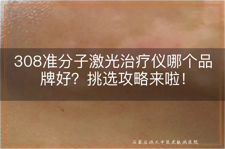 308准分子激光治疗仪哪个品牌好?挑选攻略来啦!