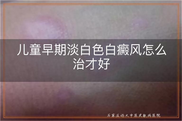 儿童早期淡白色白癜风怎么治才好