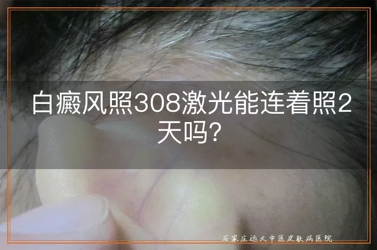 白癜风照308激光能连着照2天吗？