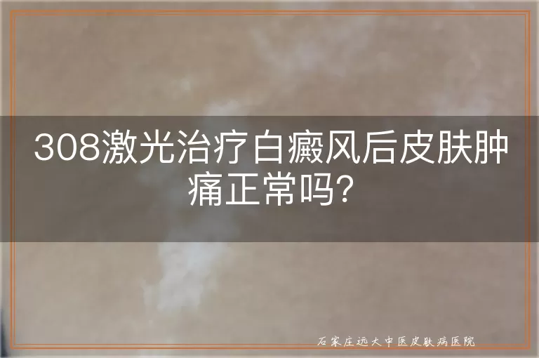 308激光治疗白癜风后皮肤肿痛正常吗?