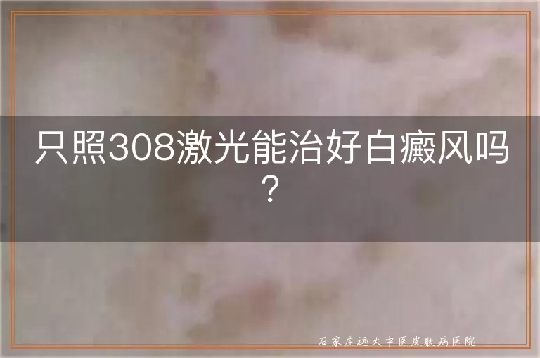 只照308激光能治好白癜风吗？