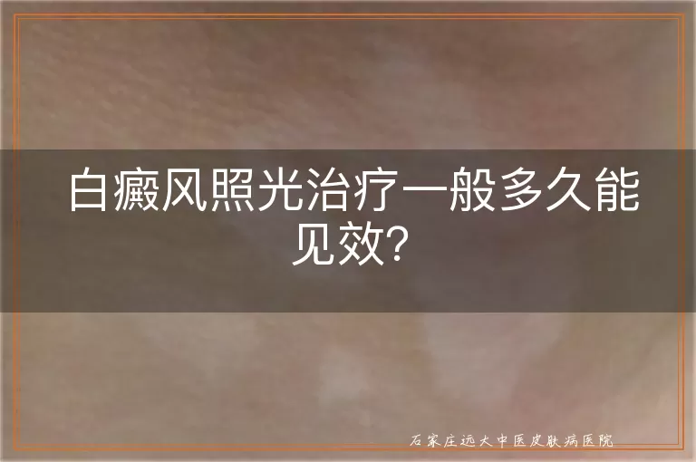 白癜风照光治疗一般多久能见效?