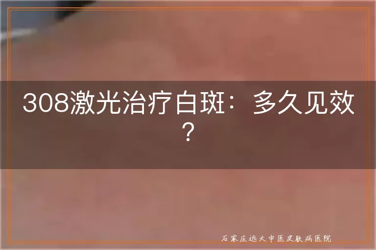 308激光治疗白斑：多久见效？