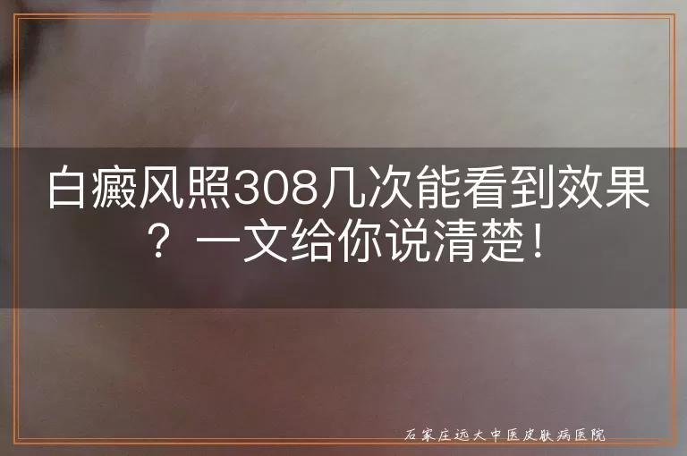 白癜风照308几次能看到效果？一文给你说清楚！
