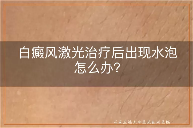 白癜风激光治疗后出现水泡怎么办？