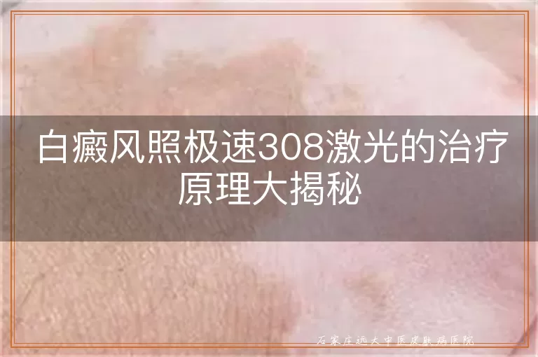 白癜风照极速308激光的治疗原理大揭秘