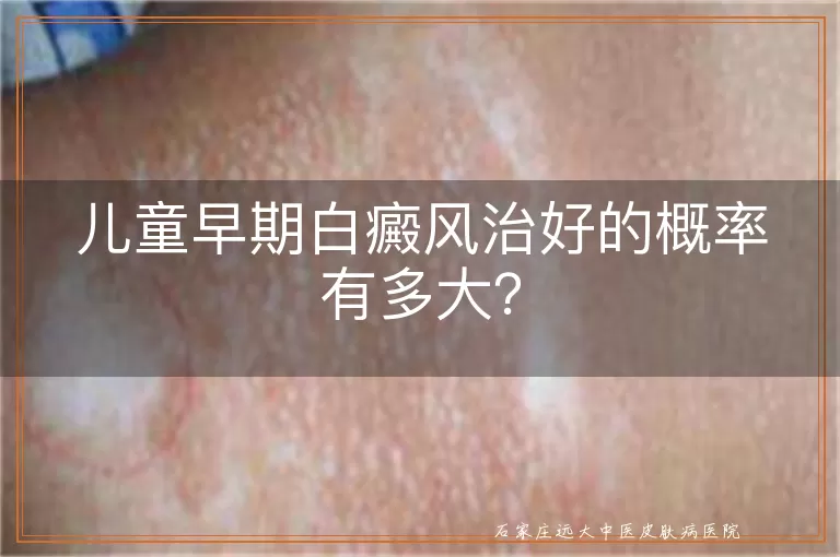 儿童早期白癜风治好的概率有多大？